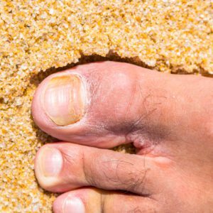 Nail Fungal Client Forms