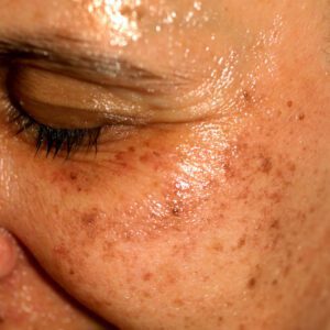 Laser Treatment Pigmented Lesions