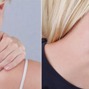 Tattoo Removal