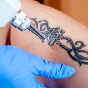 Tattoo Removal Course